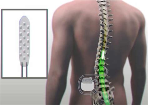 Patient Moves Paralyzed Legs With Help From Electrical Stimulation Of Spinal Cord Kurzweil