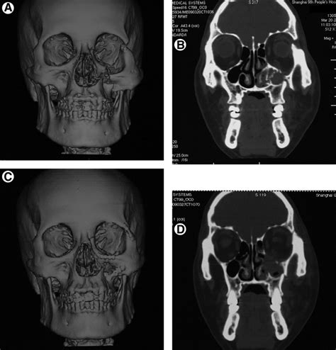 Comparisons Between Preoperative And Postoperative Ct Scans Download Scientific Diagram