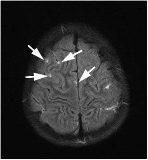 Magnetic Resonance Imaging Findings In A Patient With Cryopyrin