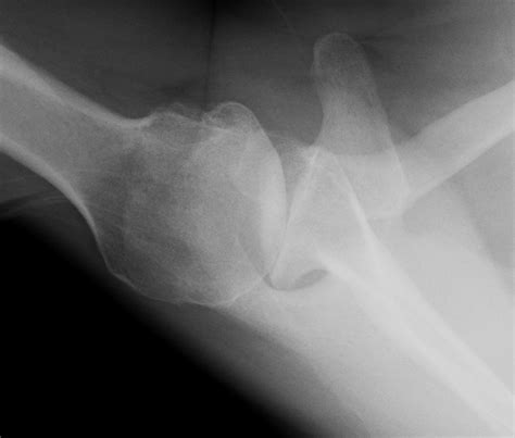 UW Shoulder and Elbow Academy: How bad is the shoulder arthritis on x-ray?