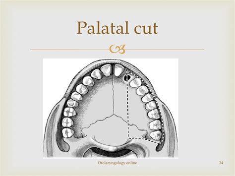 Maxillectomy a review