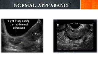 Basic gynae ultrasound