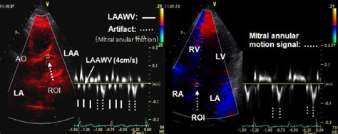 Role Of Transthoracic Left Atrial Appendage Wall Motion Velocity In