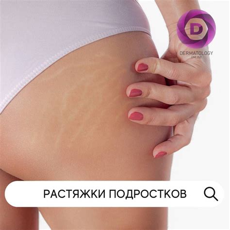 Растяжки у подростков - причины, лечение, консультация