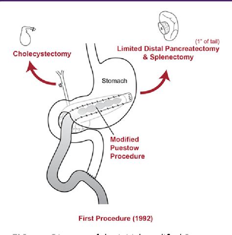 Figure 1 from Completion Pancreaticoduodenectomy for Hereditary ... 
