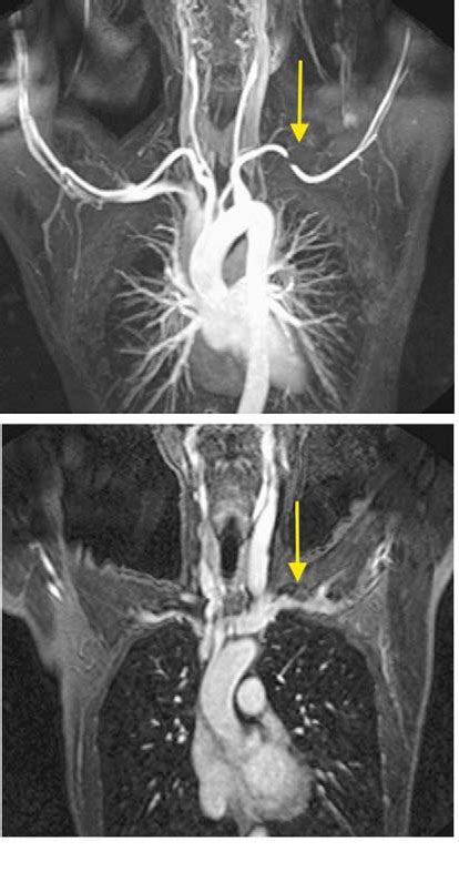 Figure 1 From Transient Thoracic Duct Obstruction In A Patient With Thoracic Outlet Syndrome