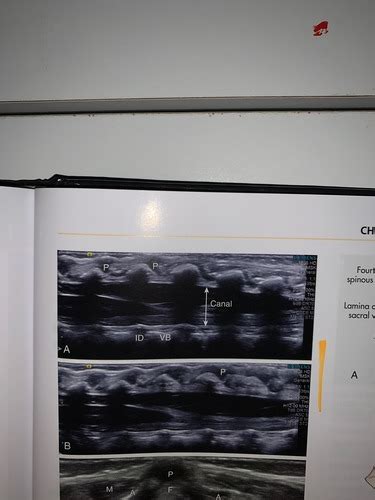 Ch Neonatal And Infant Spine Flashcards Quizlet