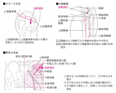 筋肉注射部位 臀部