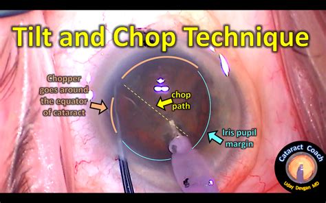 Tilt And Chop A Supracapsular Technique Cataract Coach