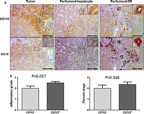 Cd133 Expression In Tumor And Peri Tumoral Tissues A Cd133 Expressed