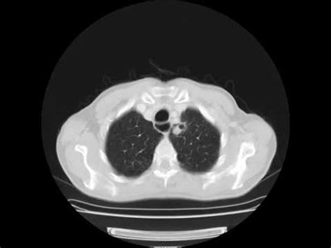 Tomografia De Paciente C Ncer Pulmonar Pr Operat Rio Youtube