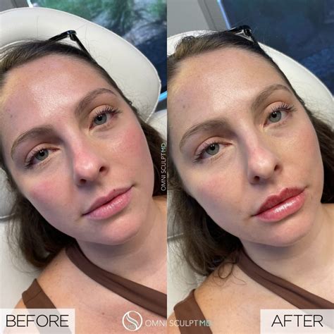 Lip Injection Before After Gallery OMNI SCULPT MD