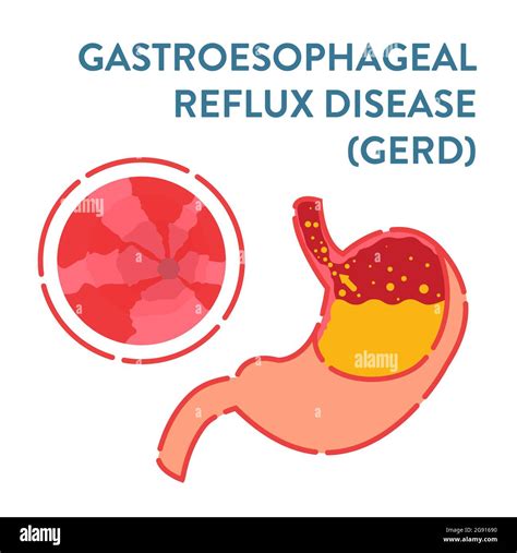 Gastroesophageal Reflux Disease Illustration Stock Photo Alamy