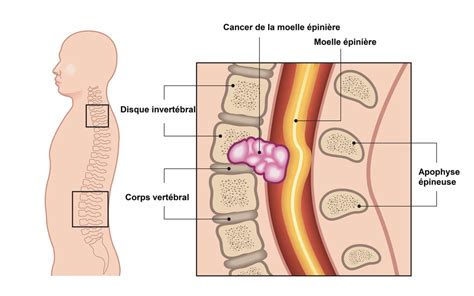 Cancer de la moelle épinière causes symptômes pronostic