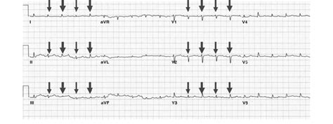 Pericardial Effusion Ecg