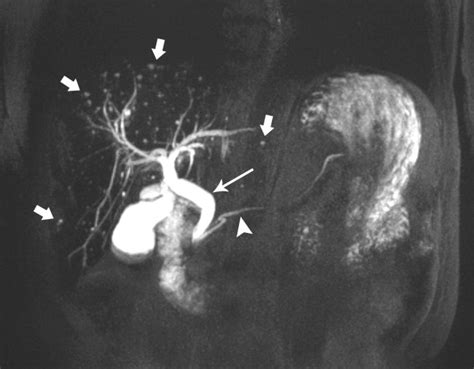 Magnetic Resonance Cholangiopancreatography Journal Of The American College Of Radiology