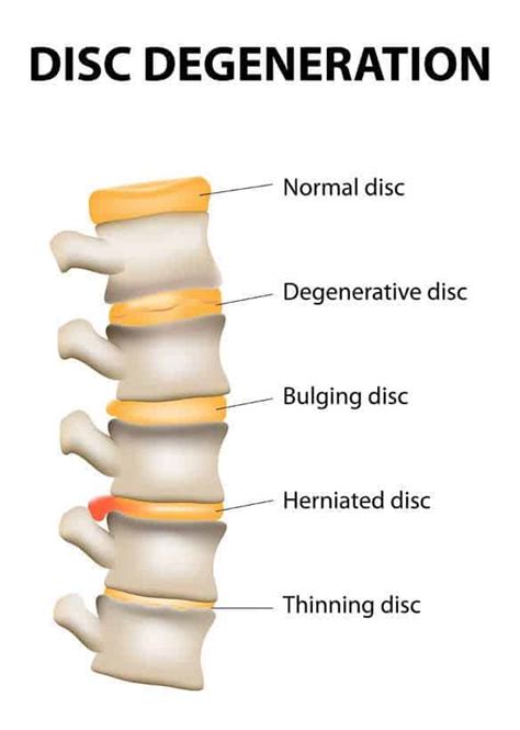 Discopatia Ou Doença Degenerativa Do Disco Clínica Dr Hong Jin Pai