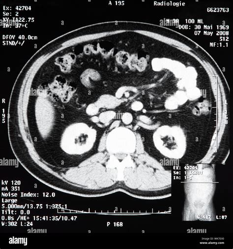 Ct scan abdomen Banque de photographies et dimages à haute résolution