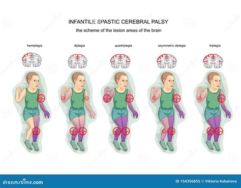 Par Lisis Cerebral Infantil Esp Stica Ilustraci N Del Vector