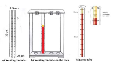 Diseases Exposed: ESR Test in the Classroom - Activity - TeachEngineering