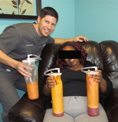 myshape lipo saves  womans life  large volume liposuction