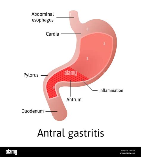 Antral Emplacement De La Gastrite Une Inflammation De La Paroi De Lestomac Trois Types