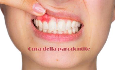 Parodontite Cura Tutto Sulla Terapia LASER UNICA SEDUTA Dentista Resta