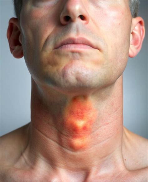 High Quality Picture Of Swollen Thyroid Gland In Neck Premium Ai Generated Image