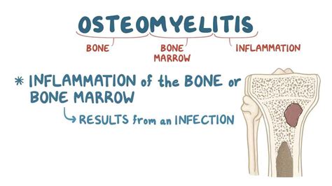 Osteomyelitis: Video, Causes, & Meaning | Osmosis