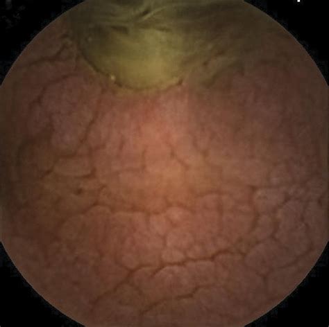 Capsule Endoscopy In Adult Celiac Disease A Potential Role In