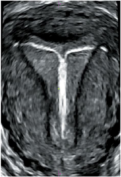 Figure From Comparison Of Two And Three Dimensional Transvaginal