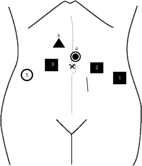 Portsite Incisional Hernia From An Mm Robotic Trocar Following Robot