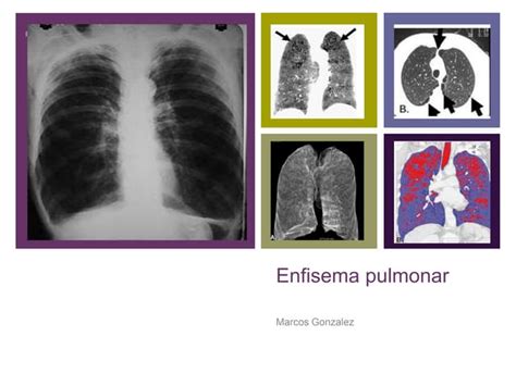 Enfisema Pulmonar Dx Ppt