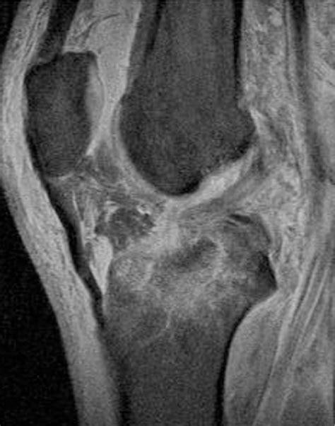 Figure 4 from MRI classification of tibial plateau fractures | Semantic ...