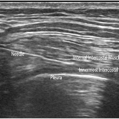 Sonogram Of The Fifth Intercostal Space In The Long Axis View Showing