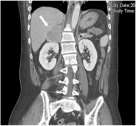 Preoperative Imaging Showed A 55 Cm Right Pheochromocytoma By Download Scientific Diagram