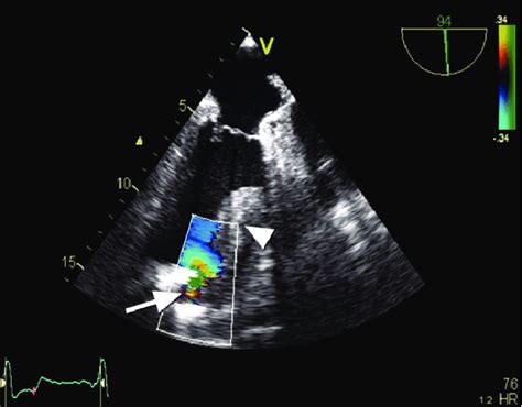 Transesophageal Echocardiogram Apical Long Axis View With Color Flow