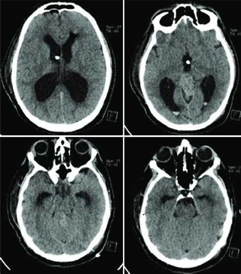 Noncontrast CT Axial Cuts Performed Day 1 After The ETV And Tumor