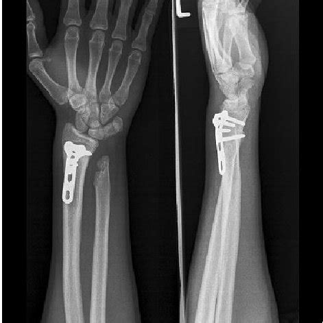 LCP Distal Radius Plates Lcp Technique Guide 2003 Synthes USA