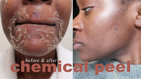 Before And After Chemical Peel Black Skin See The Wow Results