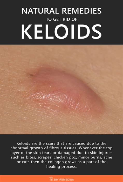 How To Get Rid Of Keloid Scars Fast Howtormeov