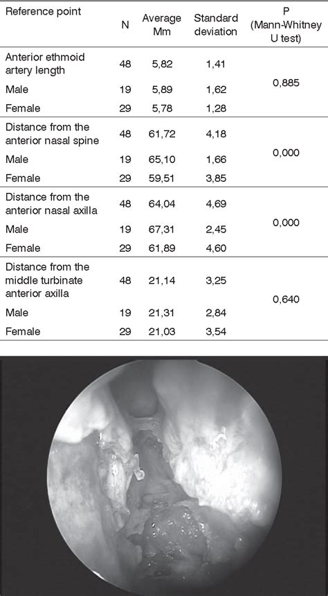 Figure 1 from Endoscopic anatomy of the anterior ethmoidal artery: a ...