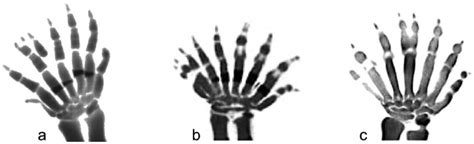 Murine Polydactyly Phenotypes Induced By Transgenic Procedures That Download Scientific Diagram