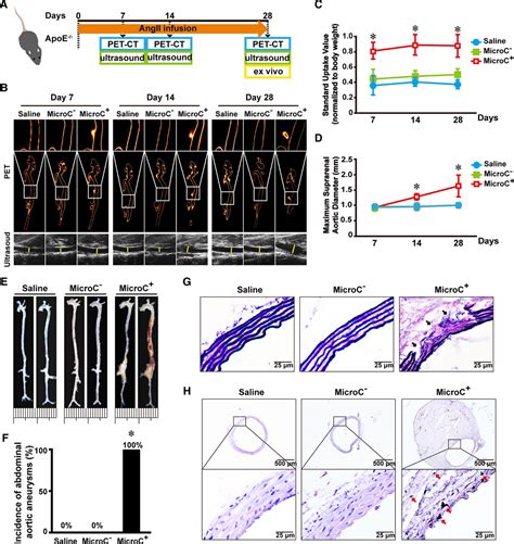 Runx2 Runt Related Transcription Factor 2 Mediated Microcalcification