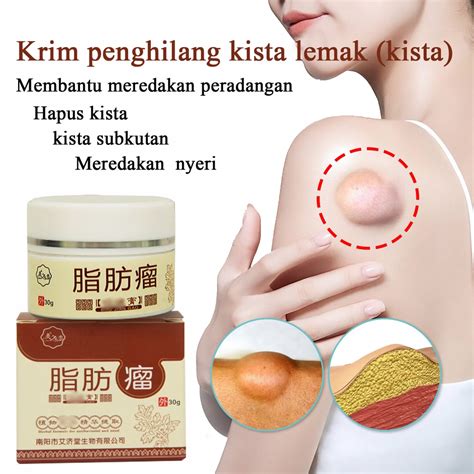 Jual Obat Lipoma Obat Oles Penghilang Benjolan Lipoma Di Tangan Obat