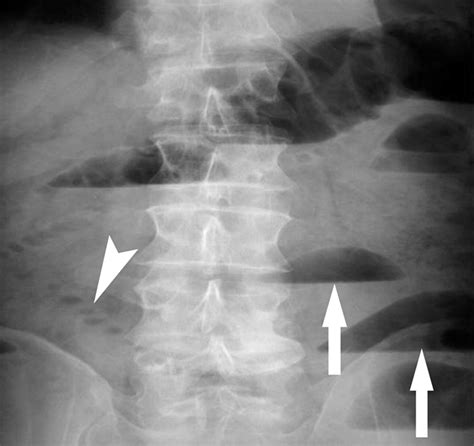 Imaging Of Acute Small Bowel Obstruction Ajr