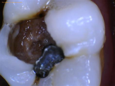 Part Of Decayed Tooth Fell Out Causes Next Step Jackson Ave