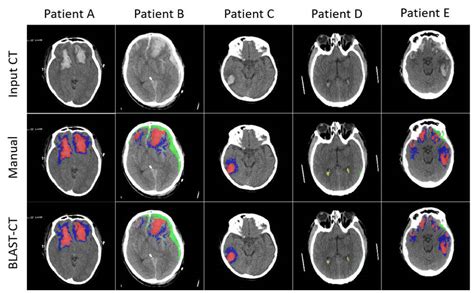 Esta Ia Puede Detectar Diferentes Tipos De Lesiones Cerebrales