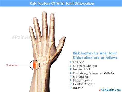 Risk Factors Of Wrist Joint Dislocation Arthritissymptoms Arthritis