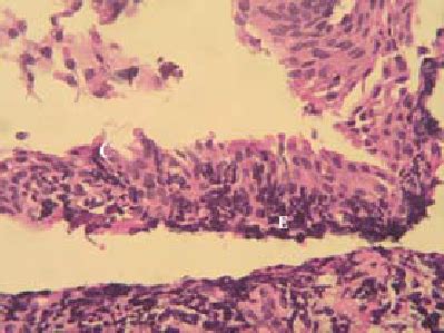 Histological Section Of A Nasopalatine Duct Cyst Following